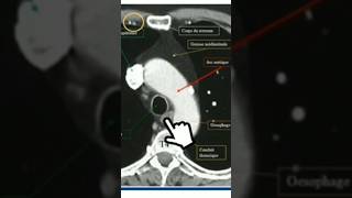 Scanner thoracique T4 anatomy medecine science anatomie scanner radiology radiologie [upl. by Zoara345]