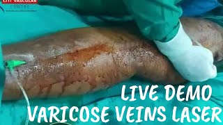 Laser Treatment for Varicose Veins  Varicose veins Laser treatment Live  live EVLT surgery [upl. by Geller]