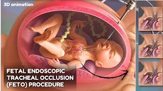 Fetal Endoscopic Tracheal Occlusion FETO procedure Animated Video [upl. by Orips]