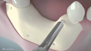 SonicWeld Rx® Dental – Shell technique for vertical defect augmentation [upl. by Eiruam]