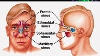 SINUS BAROTRAUMA DR FOHEID ALSOBEI [upl. by Saiff]