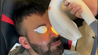 Dry eye treatment Intense PulsedLight IPL Therapy [upl. by Trix]