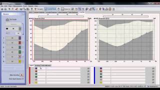 AURICAL  Tinnitus Markers in PMM [upl. by Adnalay]