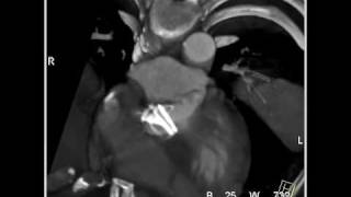 Cardiac 4D Reconstruction of a St Judes aortic valve 1 of 1 [upl. by Runstadler147]