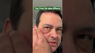 Tea Tree Oil Side Effects short [upl. by Latsyk]