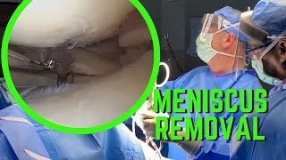 Meniscus Removal Surgery [upl. by Tiena613]