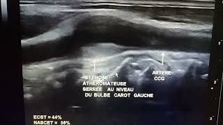 Échodoppler des TSA Sténose athéromateuse serrée [upl. by Arline433]