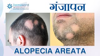 बाल झड़ना  गंजापन  Alopecia Areata Balding in patches  How to stop them Dr Rohit Batra [upl. by Haelem551]