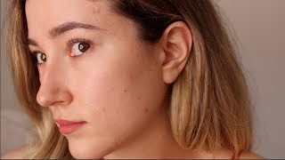 One Year Off Accutane My Acne Is Back An Emotional Update [upl. by Hovey]