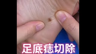 【手术实录】为什么足底色素痣需要切除？plasticsurgeon 高能 melanoma [upl. by Glynnis]