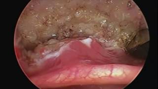 UvuloPalatoPharyngoplasty AND TONGUE BASE SURGERY [upl. by Dawson963]