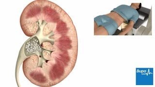 How extracorporeal shockwave lithotripsy is used to treat kidney stones  Bupa Health [upl. by Wilek347]