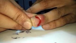 Incision and drainage of Paronychia Finger sweeling treatment [upl. by Arehahs]