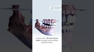 How do Aligners work 32by7 Dental Clinic [upl. by Meit173]