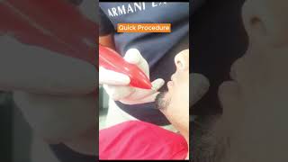 Cautery for Warts and Mole  Dr  Aftab Afzal  Aesthetics Lounge Islamabadbeauty skincare [upl. by Bradeord]