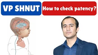 VP Shunt Patency Check StepbyStep Guide for Healthcare Professionals [upl. by Benzel]