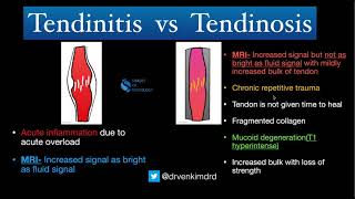 Tendinitis VS Tendinosis  Simplified [upl. by Nnaed]