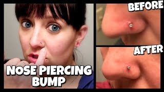 How To Get Rid Of A Nose Piercing Bump FAST  Keloid 📍 How To With Kristin [upl. by Naicul]