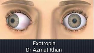 Exotropia  classification and clinical discussion Part 12 [upl. by Tila]