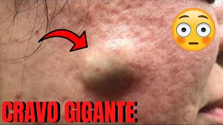 Retirando cravo Enorme Veja como tirar cravo e espinhas do Rosto Removendo cravo Gigante de nariz [upl. by Grubman618]