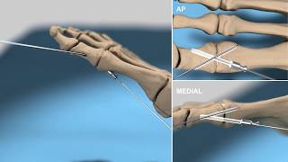 1st Metatarsophalangeal Joint Arthrodesis with ActivaScrew™ Cannulated [upl. by Etteloiv]