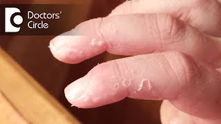 What causes skin peeling of fingers in a child  Dr Varsha Saxena [upl. by Bonnes]