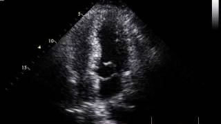 excess mitral tissue moving into the LVOT without subaortic obstruction [upl. by Arolf]