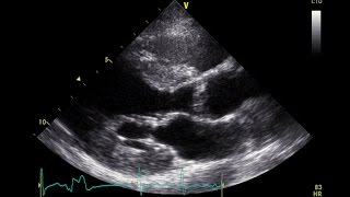 PVC Echo Parasternal Long Axis View  Aortic Stenosis [upl. by Ronda]