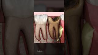 Diseases Caused By Cavities [upl. by Damita]