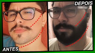 EVOLUÇÃO MINOXIDIL 1 ANO E 4 MESES Pant Foligain e Kirkland [upl. by Elleinet]