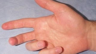 Quick SelfTest for Dupuytren’s Contracture [upl. by Yajet]