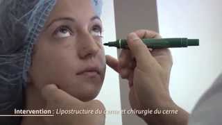 Chirurgie des cernes  Lipostructure du cerne [upl. by Nirraj]