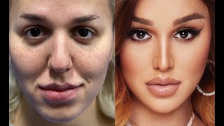 My Facial Feminization Surgery Part 2  La Demi [upl. by Gimble232]