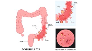 Divertikulitis [upl. by Daus]