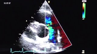 Pulmonalklappe mit Farbdoppler pulmonary valve with color Doppler [upl. by Lorain]