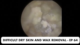 DIFFICULT DRY SKIN AND EAR WAX REMOVAL  EP 64 [upl. by Ikkir]