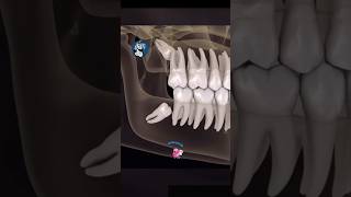 Wisdom Teeth The Jaw Pain You Didnt Expectdentalcare dentalcare tooth jawpain [upl. by Annaeerb]