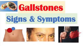 Gallstones Signs amp Symptoms Why They Occur  Cholecystitis Choledocholithiasis Cholangitis [upl. by Acirt]