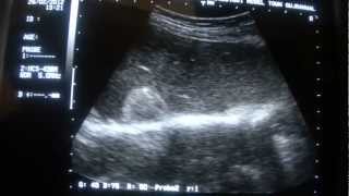 ULTRASOUND LIVER HEMANGIOMAS [upl. by Eiramik]