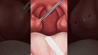 ASMR remove tonsil stone treatment Tonsil stone removal from deep hole 2d animation [upl. by Ahgem126]