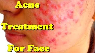 acne treatment for face [upl. by Enialed]