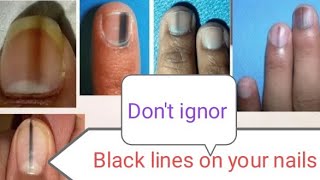 Black lines on nails what to doDon’t Ignore if black line on Your Nailsai nailsinstagram [upl. by Ellerred]