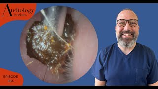 Surprising Earwax Removal Twist and Peel  EP864 [upl. by Ellinad]