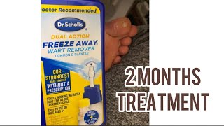 How to remove warts with Dr Scholls Dual Action I Freeze away wart remover common amp plantar [upl. by Edahsalof]