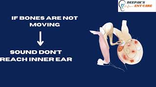 WHAT IS OTOSCLEROSIS [upl. by Nolyarg]