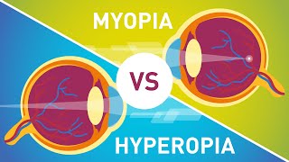 Difference between Myopia Near Sightedness amp Hyperopia FarSightedness [upl. by Eeryk]