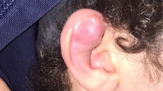 What is a Cauliflower ear [upl. by Grati9]