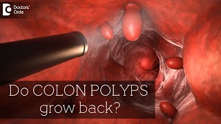 HOW FAST DO COLON POLYPS GROW BACK  Diagnosis amp Prevention  Dr Rajasekhar M R Doctors Circle [upl. by Zahc]