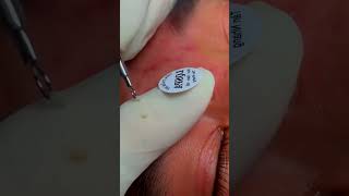 blackhead removal acne blackhead blackremoval [upl. by Yaya]