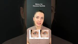 Botox for hooded eyelids  Dr MediSpa [upl. by Way]